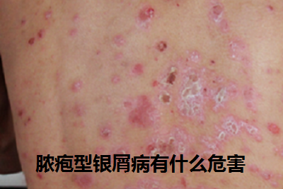 银屑病是一种常见的慢性皮肤病,其中脓疱型银屑病的危害性很大,很多