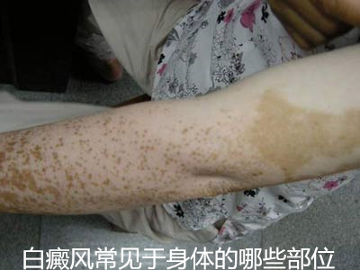 白癜风常见于身体的哪些部位?