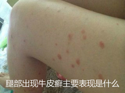 腿部出现牛皮癣主要表现是什么?
