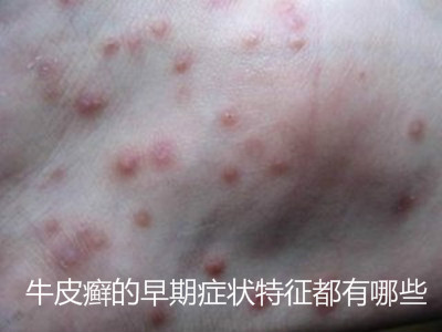 牛皮癣的早期症状特征都有哪些?