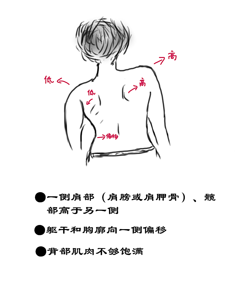 一侧肩部(肩膀或肩胛骨),髋部高于另一侧;两腿不等长;躯干和胸廓向
