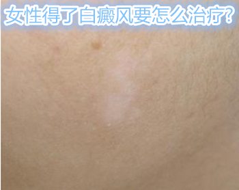 白癜风的发病前期,患者发病时间短,白斑面积小,黑色素细胞尚未被有效
