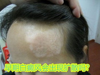 下面请 北京方舟皮肤病医院的医生讲解一下,希望大家可以了解.