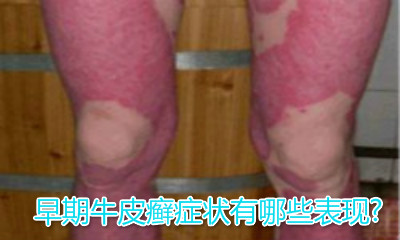 早期牛皮癣症状有哪些表现?