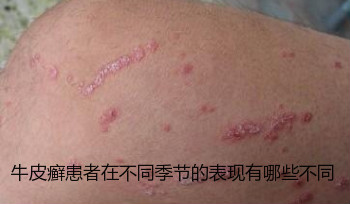 牛皮癣症状    在日常生活当中牛皮癣是非常常见的一种皮肤疾病,会对