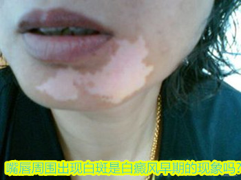 嘴唇周围出现白斑是白癜风早期的现象吗?