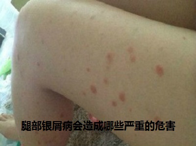 腿部银屑病会造成哪些严重的危害