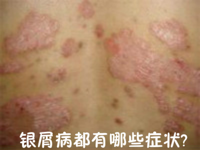 皮肤病 方舟银屑病 牛皮癣症状    银屑病都有哪些症状?