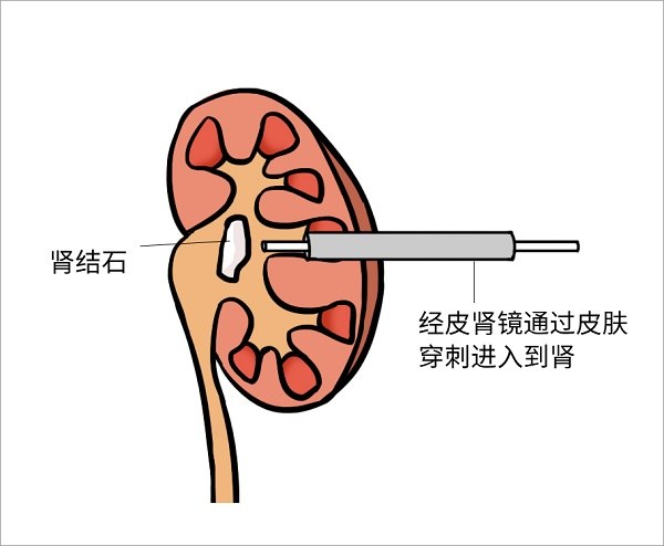 图四:经皮肾镜取石术示意图