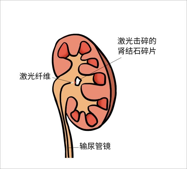 图五:输尿管镜取石术示意图那这个就是软镜,是现在先进的方法.