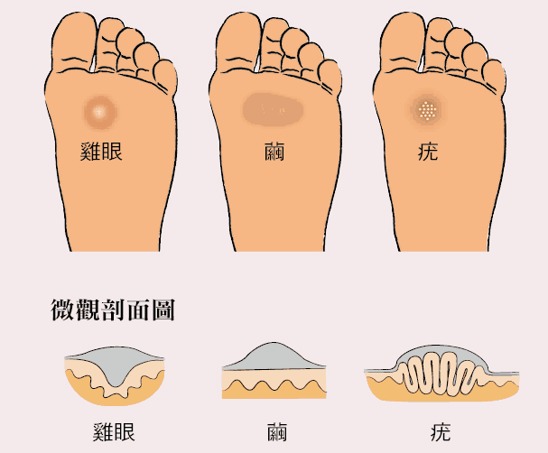 脚底长了小疙瘩是鸡眼还是疣不注意3点区别可能会反复发作