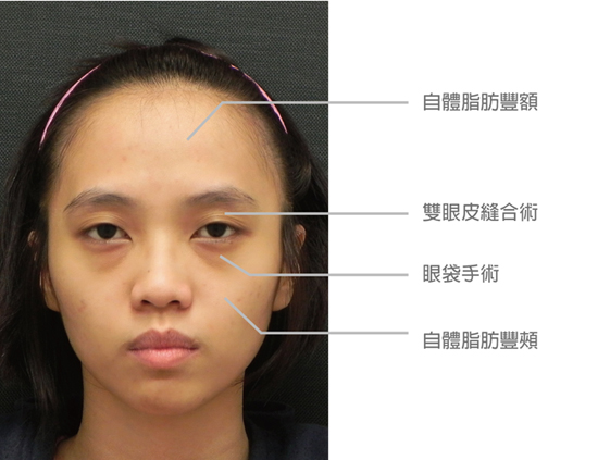 台湾女孩整型整掉苦命脸 网友大赞案例经典