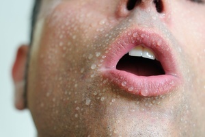 痤疮也叫青春痘,是种症状比较明显的皮肤病,在我们生活中的周围可以