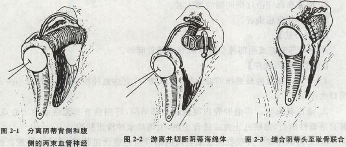 阴蒂肥大