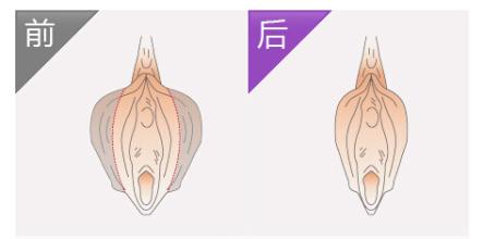 阴蒂肥大