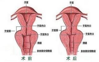 阴蒂肥大