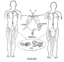 丝虫病