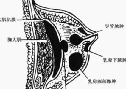 急性化脓性乳腺炎