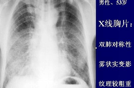 急性间质性肺炎