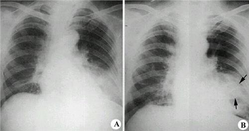 急性间质性肺炎