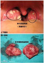 扁桃体结石