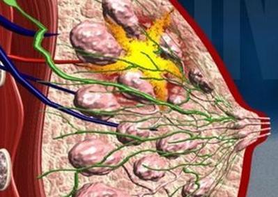 炎性乳腺癌