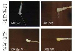 白带发黄