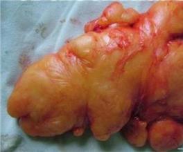 皮下脂肪瘤的症状图片,皮下脂肪瘤图片大全_皮下脂肪瘤_39疾病百科