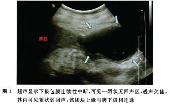 脾破裂的症状图片,脾破裂图片大全_脾破裂_39疾病百科