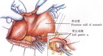 贲门癌的症状图片,贲门癌图片大全_贲门癌_39疾病百科