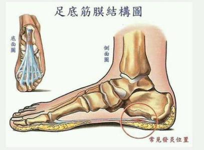 足底筋膜炎的症状图片,足底筋膜炎图片大全_足底筋膜
