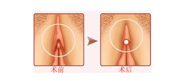 阴蒂肥大
