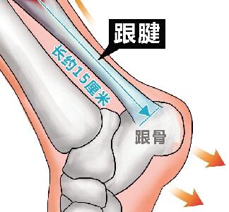 跟腱损伤