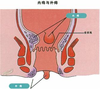 内痔脱出