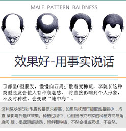 上海种植头发哪家好_植发多少钱