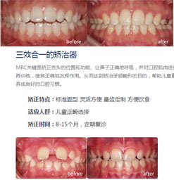 上海牙齿矫正手术费用_上海隐形矫正医院