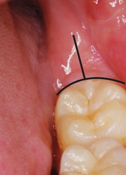 在近中上倾中位阻生智齿的拔除时,亦可使用丁字形切口,即在第二磨牙远