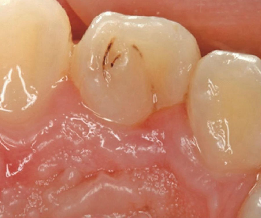【图】牙体解剖:前牙,前磨牙,磨牙