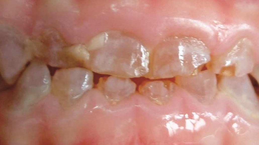 遗传性牙本质发育不全