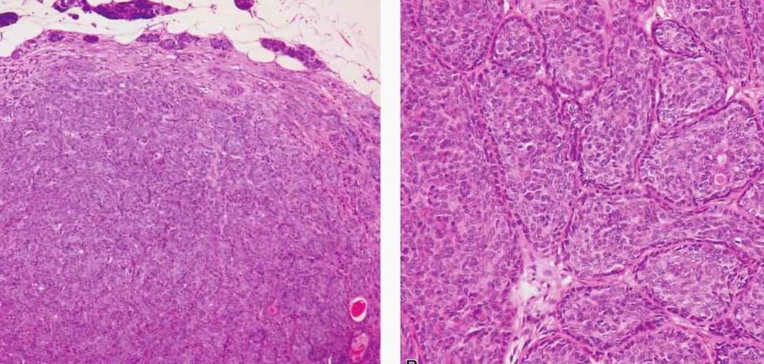 【图】基底细胞腺瘤详细图解(唾液腺良性肿瘤的临床病理)