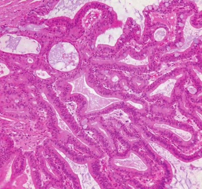 图7-93 囊腺瘤:肿瘤细胞似warthin瘤的柱状细胞