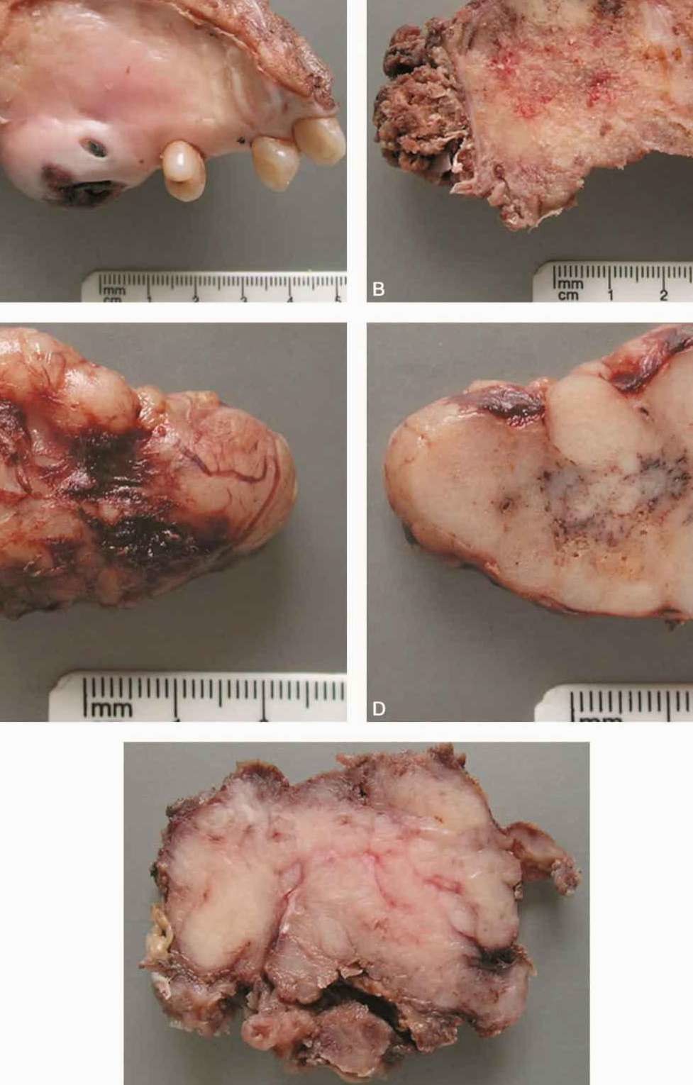 【图】腺样囊性癌详细图解(唾液腺恶性肿瘤的临床病理