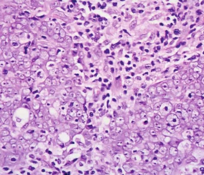 图7-289 淋巴上皮癌:肿瘤细胞拥挤,可见细胞核重叠