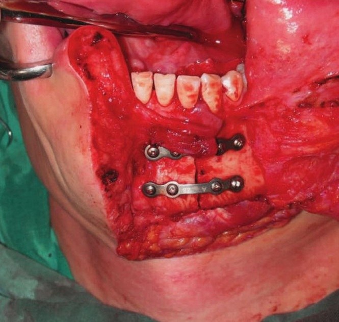 【图】腮腺深叶肿瘤及咽侧小唾液腺肿瘤切除术