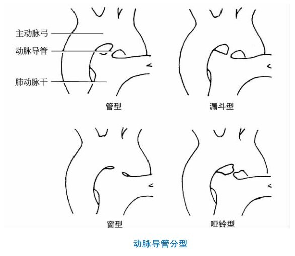 【图】先天性动脉导管未闭与手术关闭治疗操作