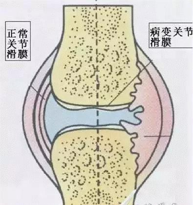 1,滑膜炎患者会出现关节积液现象,这主要是因为关节部位受到炎症的