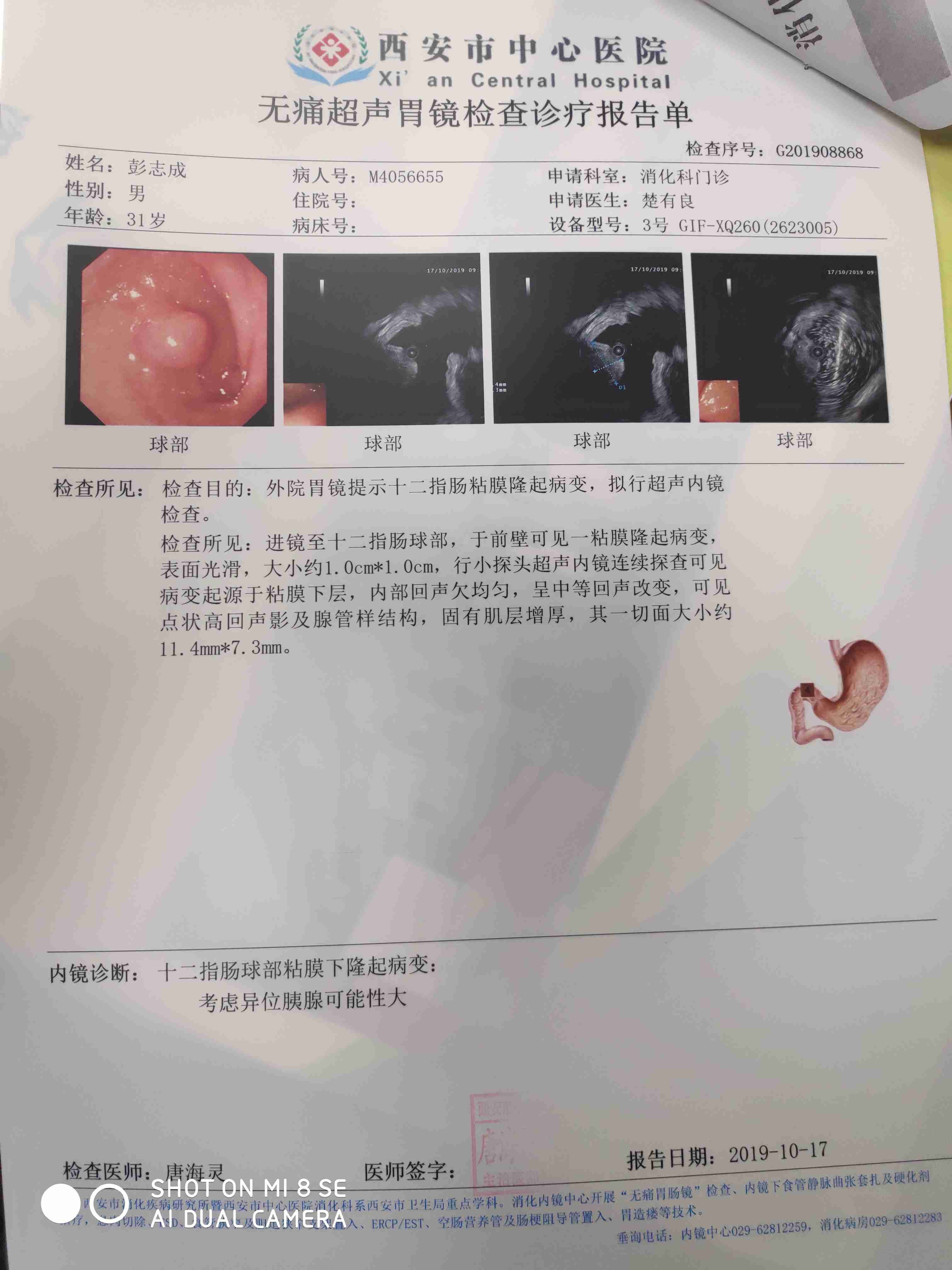 病情描述:你好,我的超声胃镜检查结果是十二指肠球部粘膜下隆起,考虑