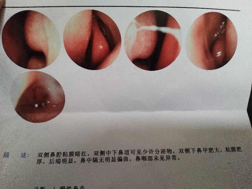 男23岁,鼻炎查了鼻内镜里面有水肿(图4