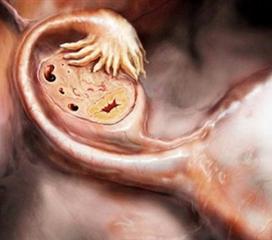 卵巢妊娠