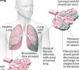 肺间质纤维化